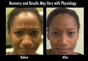 Beverly Hills Dysport| Patient Results For Severe Frown Line
