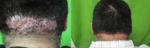 Acne Keloidalis Nuchae Surgery Results For Bump on Back of Head - before and after photo