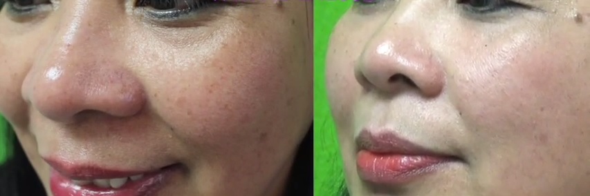 Non-Surgical Cheek Lift| Patient Photos- Radiesse