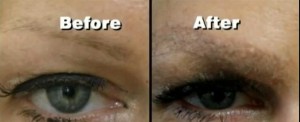 Eyebrow Hair Transplant| Thicker brow density & shape