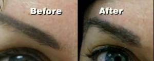 Before and After Eyebrow Transplant in Reondo Beach CA 