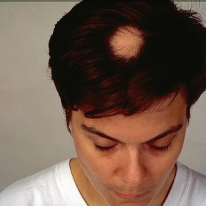 Alopecia Areata| Hair Loss & Immune Disorders