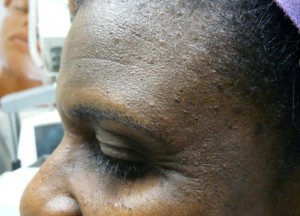 Before Dermatosa Papulosa Nigra Procedure 