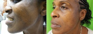 los-angeles-dermatosa-papulosa-nigra before and after