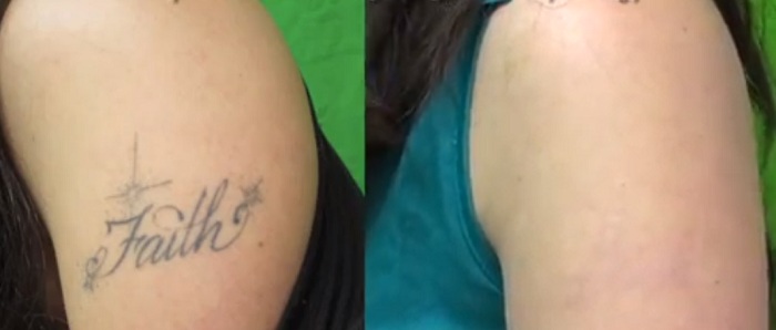 Successful Tattoo Removal Results - Los Angeles Patient