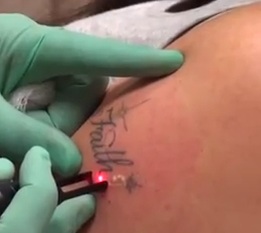 Removing Tattoo Ink With Laser| Breaking Up Ink Below the Skin