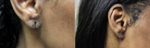 Before and After Split Earlobe Treatment in Redondo Beach CA 