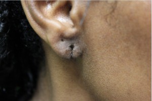 los-angeles-split-earlobe-repair before repair