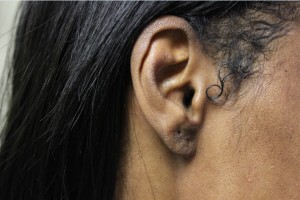 split earlobe repair result in a los angeles patient