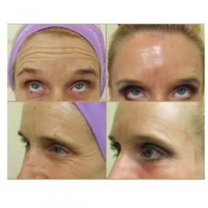 Botox results for crows feet wrinkles & frown lines| Patient results- before and after