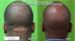 razor bumps back of head before and after treatment