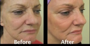 age spots treatment results from fraxel repair laser in a los angeles patient 