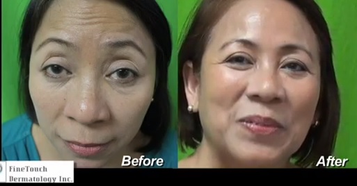 Belotero for Forehead Lines and Wrinkles