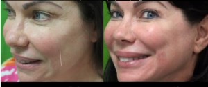 belotero for fine cheek lines before and after