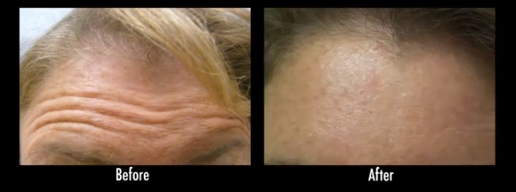 Botox| Treatment for Facial Expression Wrinkles