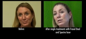 Before and after age spots treatment from fraxel repair laser in a los angeles patient 