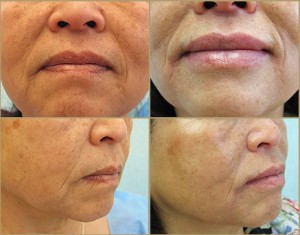 Results of Lip Enhancement Using Juvederm