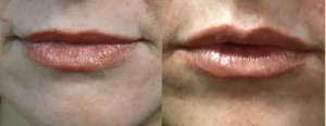 juvederm lip enhancement in a los angeles patient