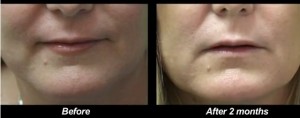 los-angeles-non-surgical-jowl-lift-787