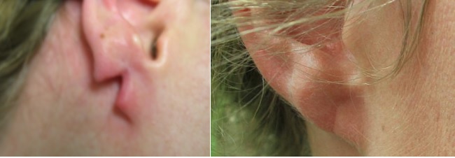 Split Earlobe Repair Services|Office of Dr. U - Los Angeles & South Bay