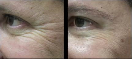 Wrinkle Removal Results| Los Angeles