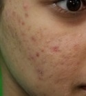 Close Up Photo| Acne Scars on Patient