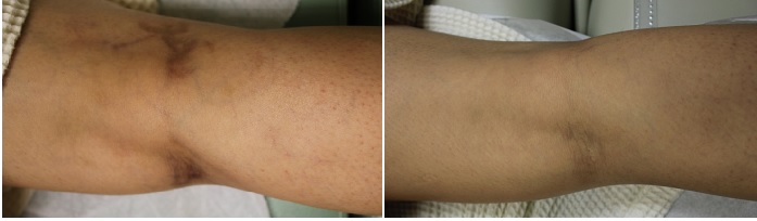 Vein Removal Los Angeles  Best Treatment for Varicose Veins