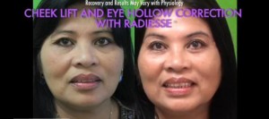 Restoring Facial Volume| Non-Surgical Cheek Lift With Radiesse