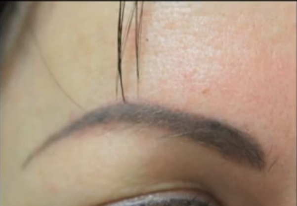 Tattooed Brows Before Transplantation With Nape Hair