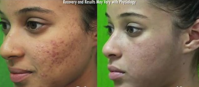 Acne Scar Improvements| Before & After Fraxel Dual