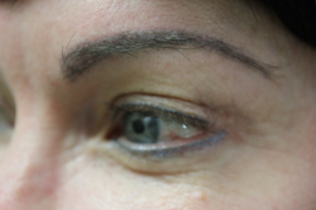 After eyebrow restoration with UGraft FUE