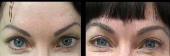 Fuller Eyebrows With FUE Surgery