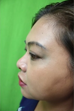 Los Angeles Patient Before Her Non-Surgical Nose Job With Radiesse