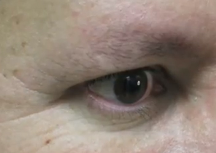 Male Patient Before FUE Eyebrow Transplant