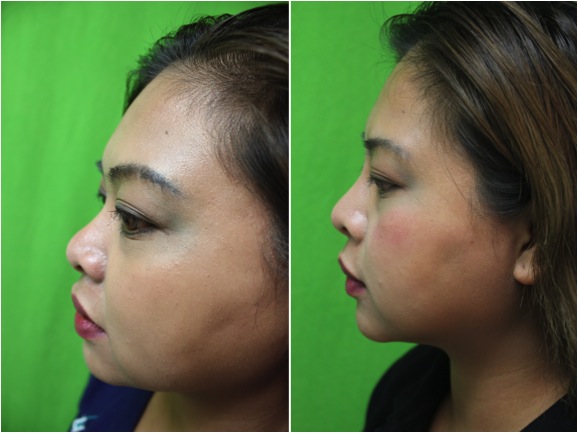 Los Angeles Patient- Nonsurgical Nose Job