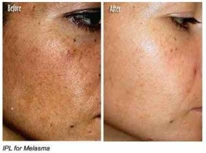 hyperpigmentation laser treatment 