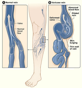 los-angeles-laser-varicose-vein-removal-www.wikipedia.com