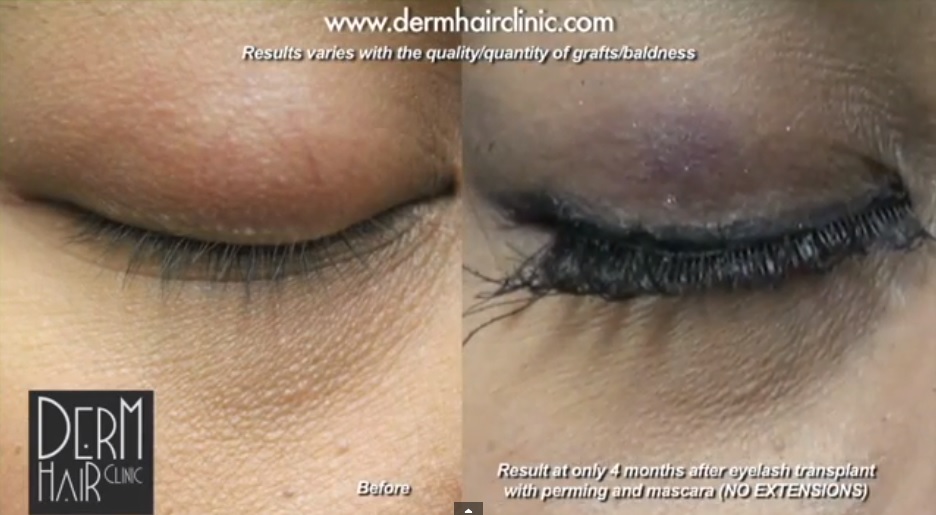 eyelash-hair-transplant-083