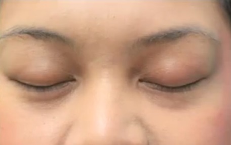 Patient's Eyelashes Before Her Transplant Surgery