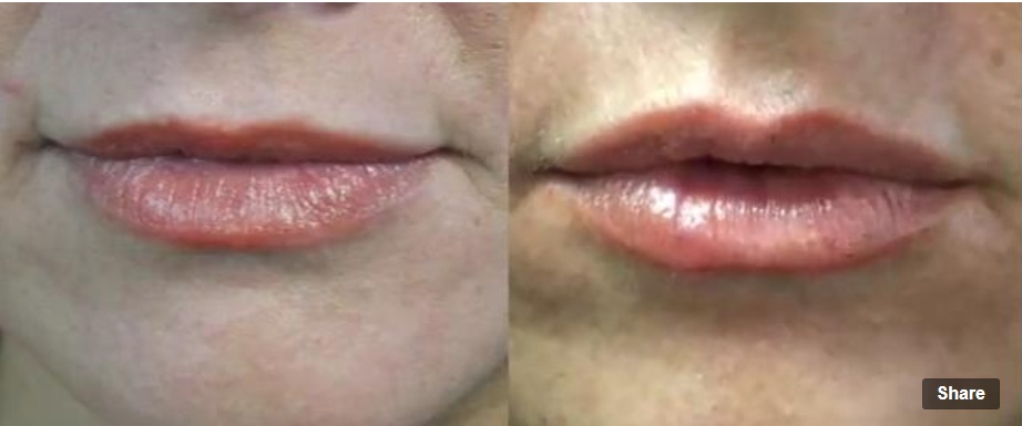 Augmented Lips With Juvederm| Before and After