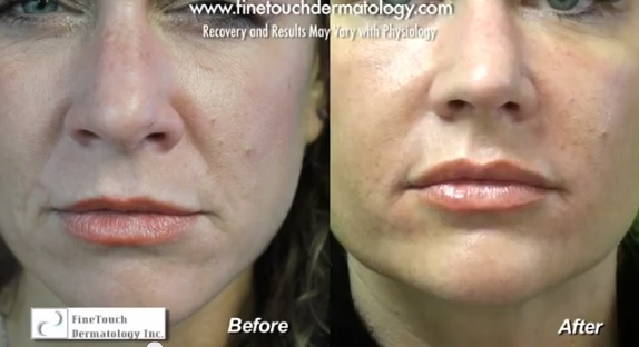 Laugh Lines Treated With Radiesse| Before and After Photos