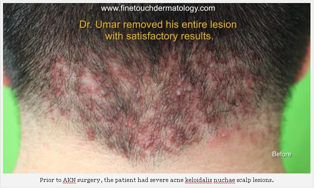 Acne Keloidalis Nuchae, Black Skin Acne, african acne ...