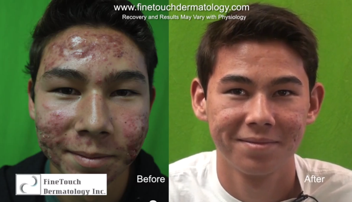 Conquering Severe Acne| Laser Treatment Results