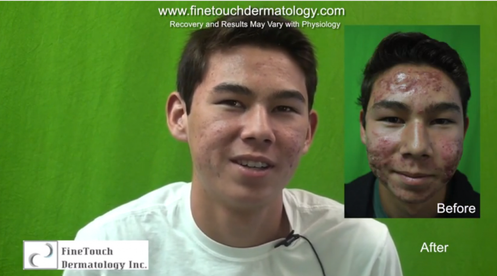 photodynamic Acne treatment result