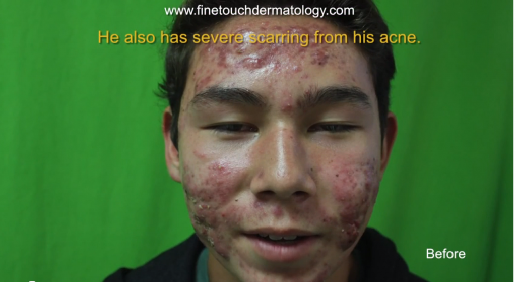 Male patient|severe nodulocystic acne -before treatment