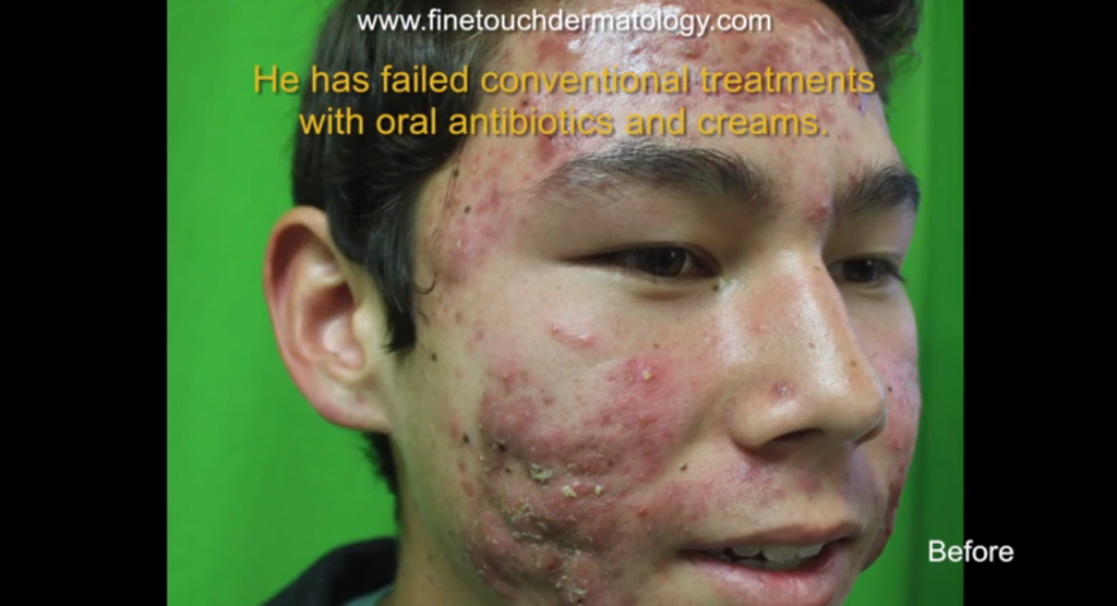 Light & Photodynamic Acne Treatment Patient - Before Image