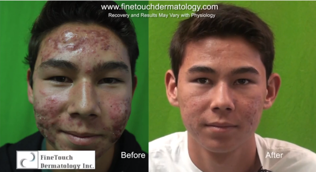 Results of Laser Acne Treatment For Severe Nodulocystic Case