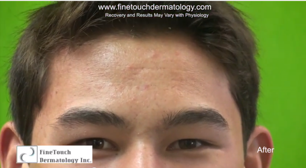 Close Up View of Patient's Results For Severe Acne