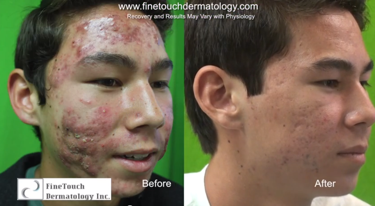 Acne Scar Treatment