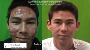 Acne and Scar Laser Treatment| Patient's Results